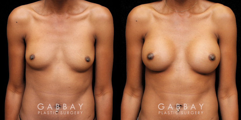 Patient 09 Front View Breast Augmentation with Silicone Implants Gabbay Plastic Surgery