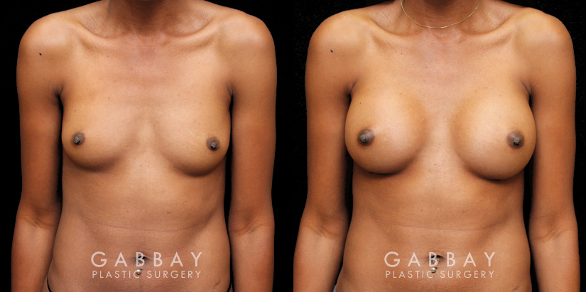 Patient before-and-after photos for breast augmentation with silicone implants. Patient increased cup size while maintaining a natural, balanced look to the breasts.