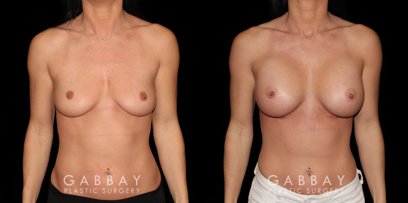 Patient breasts with silicone implants following complete recovery. Now how the incisions are hidden in the breast folds, making them invisible from most angles.