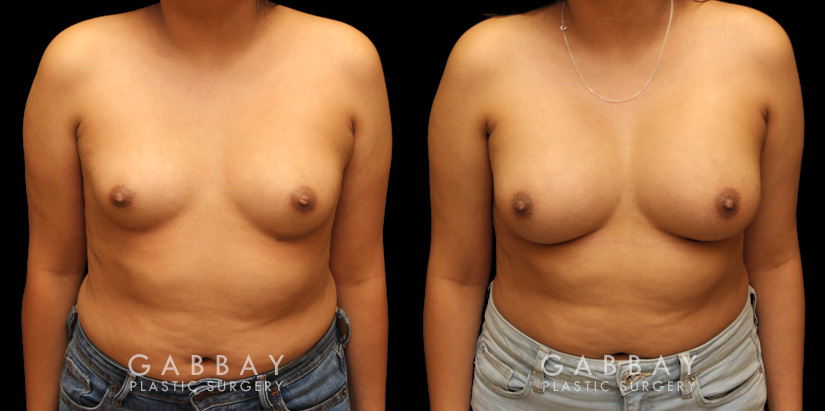 Using silicone implants, patient wanted a mild boost to breast volume without dramatic results. The final look has enhanced roundness while keeping to the patient’s natural breast shape and position before the procedure.