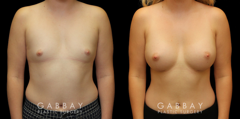 Patient results for breast augmentation with silicone implants. Before there was minimal breast volume, with the results increasing size without damaging the skin around the breasts. Note the lack of visible scarring.