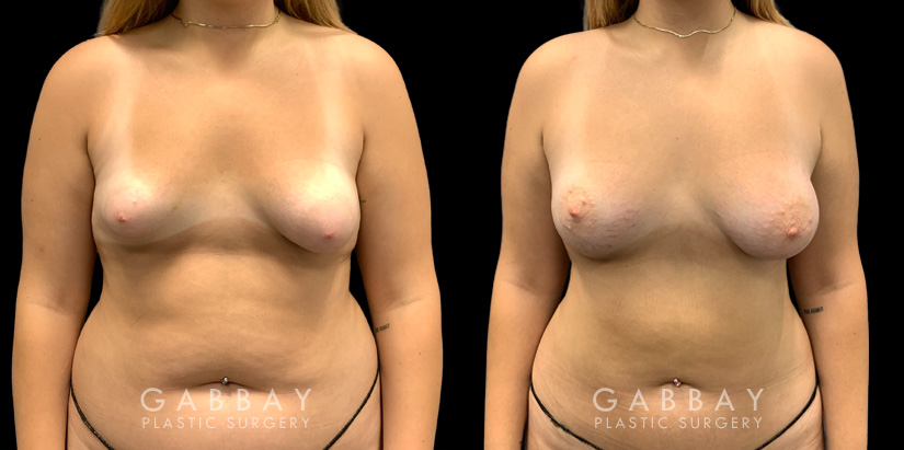 Patient 11 Front View Breast Fat Grafting Gabbay Plastic Surgery