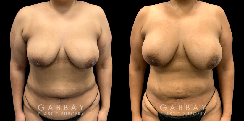 Patient 15 Front View Breast Fat Grafting Gabbay Plastic Surgery
