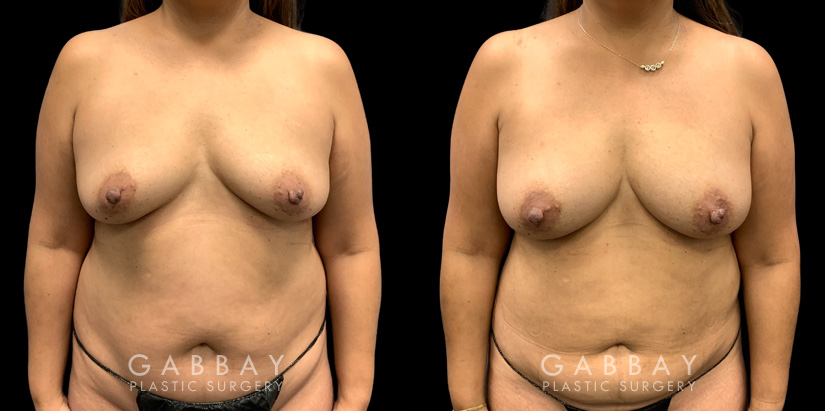 Patient 16 Front View Breast Fat Grafting Gabbay Plastic Surgery