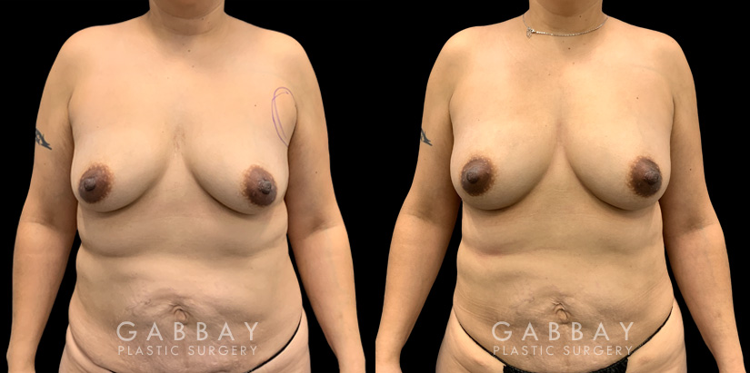 Patient 17 Front View Breast Fat Grafting Gabbay Plastic Surgery