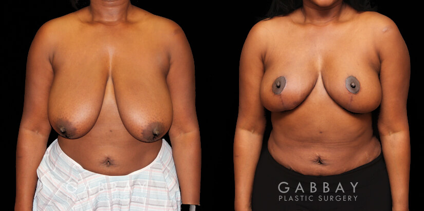 Patient 01 Front View Breast Reduction with Lift Gabbay Plastic Surgery