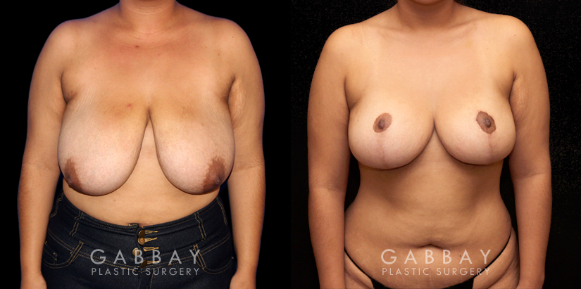 Patient 03 Front View Mastopexy Gabbay Plastic Surgery