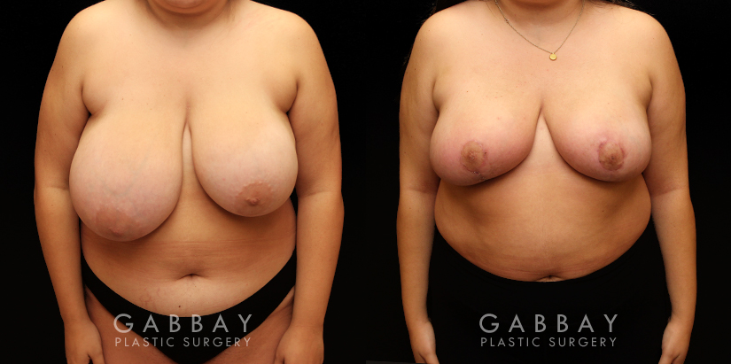 Patient 05 Front View Breast Reduction Gabbay Plastic Surgery