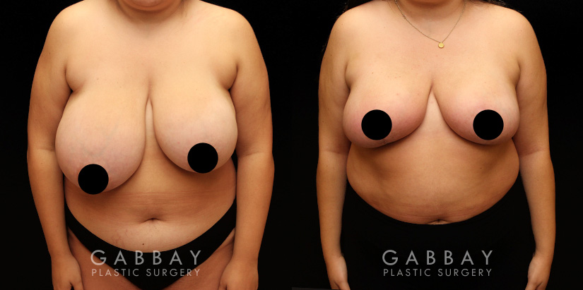 Patient 05 Front View Breast Reduction Gabbay Plastic Surgery