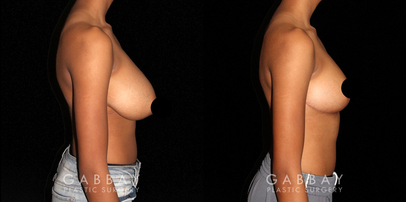 Patient 04 Right Side View Breast Reduction Gabbay Plastic Surgery