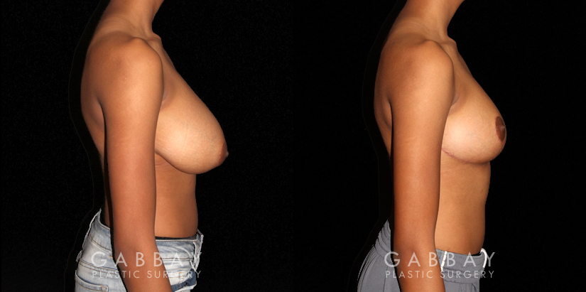 Breast Reduction Beverly Hills Patient 04 Right Side View Gabbay Plastic Surgery
