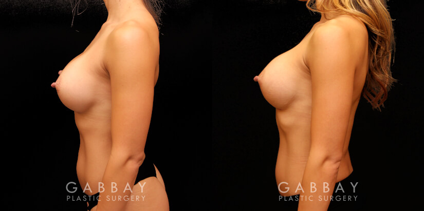 Patient 01 Left Side View Breast Revision Gabbay Plastic Surgery