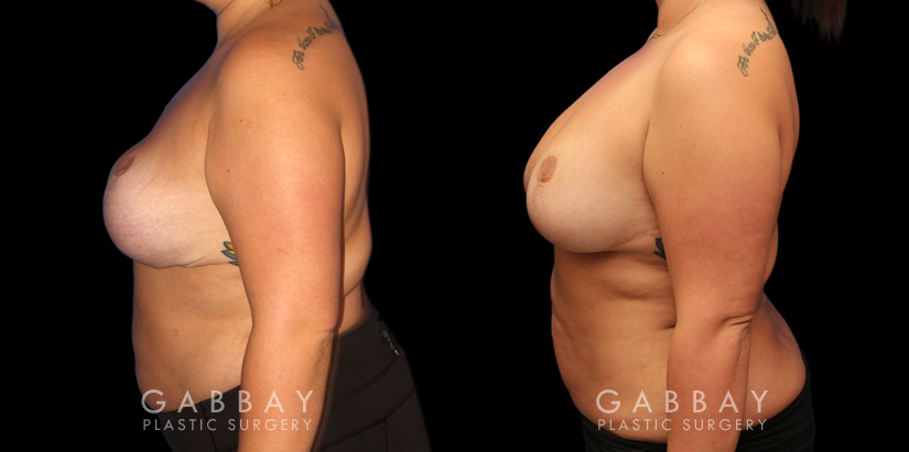 Patient 03 Left Side View Revision Breast Reduction, Revision Wide Mastopext, Belladerm Gabbay Plastic Surgery