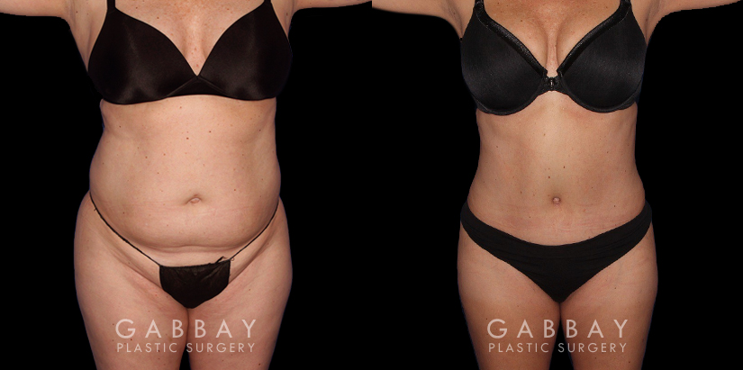 https://www.gabbayplasticsurgery.com/wp-content/uploads/1-13.jpg