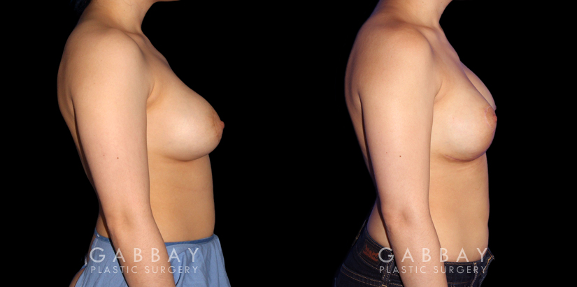 Patient 06 Right Side View Breast Augmentation-Remove and Replace Saline & Full Lift Gabbay Plastic Surgery