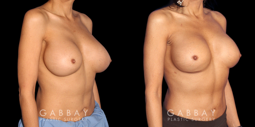 Patient 07 3/4th Right Side View Breast Revision Gabbay Plastic Surgery