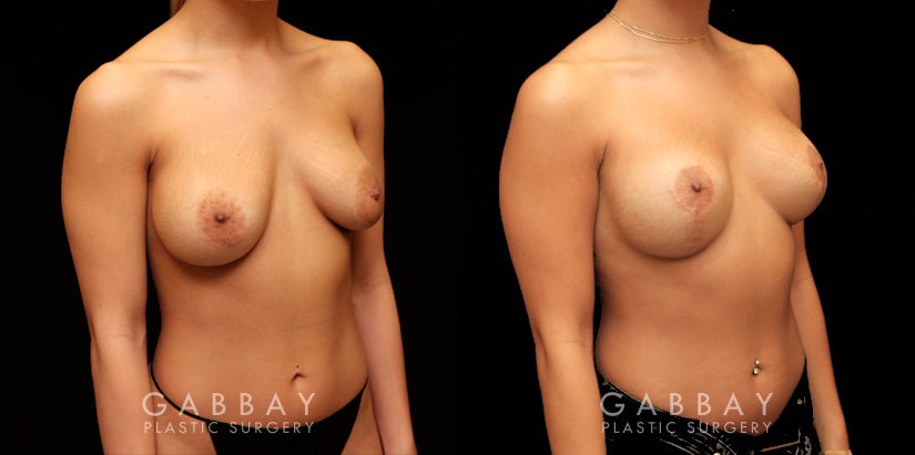 Patient 13 3/4th Right Side View Removal and Replacement of SIL Implants Capsulorrhaphy Gabbay Plastic Surgery