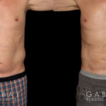 Male patients with liposuction results for full abdominal contouring. Patient healed well with minimal visible scarring and a flat stomach as seen in the profile view.
