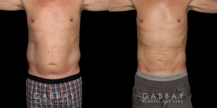 Male patients with liposuction results for full abdominal contouring. Patient healed well with minimal visible scarring and a flat stomach as seen in the profile view.