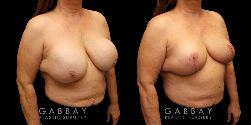 Patient 17 3/4th Right Side View Implant Removal and Lift Gabbay Plastic Surgery