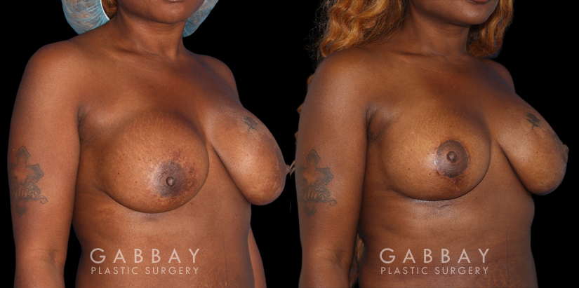 Patient 18 3/4th Right Side View Breast Revision Gabbay Plastic Surgery