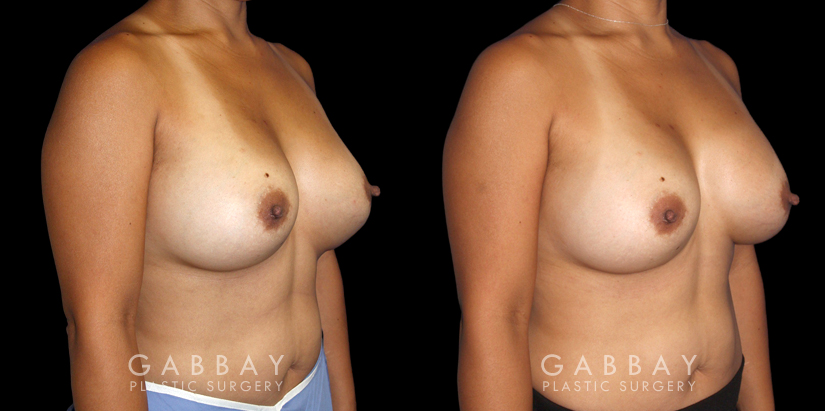 Patient 19 3/4th Right Side View Breast Revision Gabbay Plastic Surgery