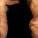 Female patient’s liposuction results, tightening her abdomen area significantly while minimizing any scarring. Patient recovered without complications and enjoyed an enhanced visibility of her natural curvy contours.