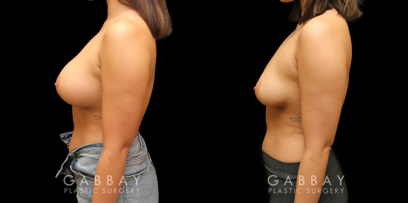 Patient 08 Left Side View Implant Removal and Lift Gabbay Plastic Surgery