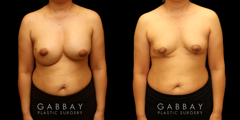 Patient 09 Front View Breast Implant Removal and Lift Gabbay Plastic Surgery