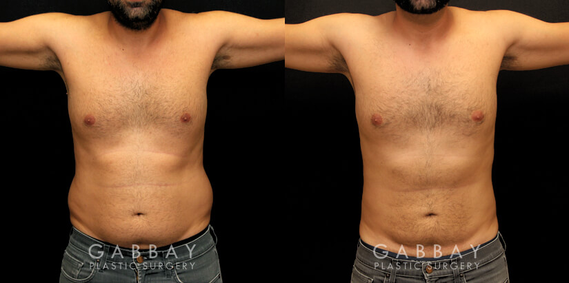 Patient 01 Front View Liposuction and J Plasma to Full Abdomen Gabbay Plastic Surgery