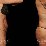 Liposuction before-and-after for female patient who wanted subtle fat removal around the lower abdomen to target stubborn belly fat. Her results show a decrease in lower abdominal bulge for a flatter contour.