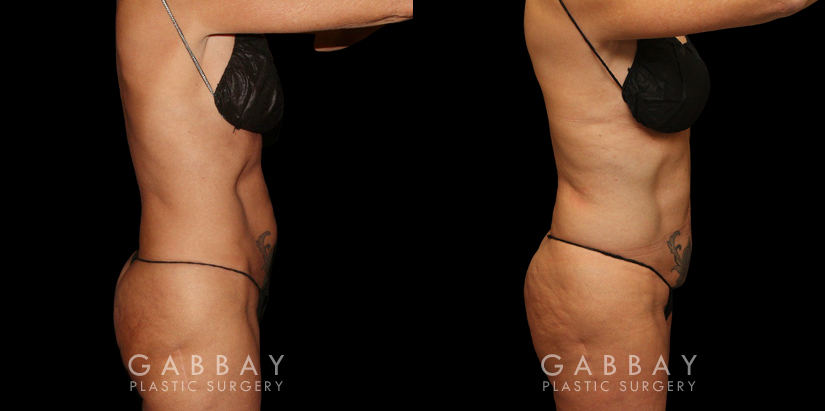 Liposuction before-and-after for female patient who wanted subtle fat removal around the lower abdomen to target stubborn belly fat. Her results show a decrease in lower abdominal bulge for a flatter contour.