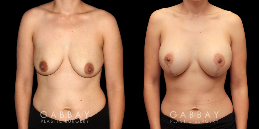 Patient 08 Front View Scar Revision to Breasts Gabbay Plastic Surgery