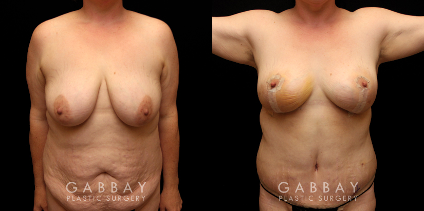 Patient 11 Front View Tummy Tuck and Breast Lift Gabbay Plastic Surgery