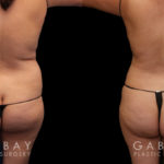 Abdominal liposuction results for female patient who wanted to address stubborn belly fat that did not respond to diet and exercise. Results show reduced overall profile that also lends itself to her natural body shape and features.