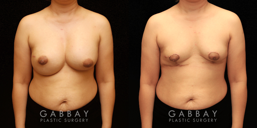 Patient 13 Front View Breast Implant Removal and Lift Gabbay Plastic Surgery