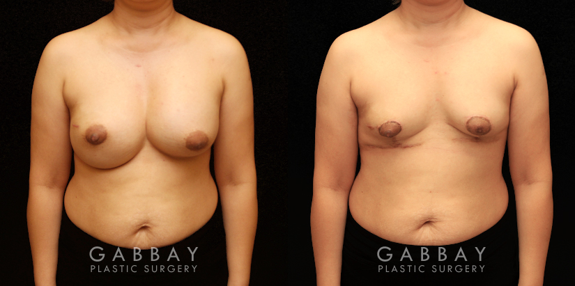 Breast implant removal and lift