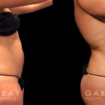 Female patient showing results of her 360 liposuction with a focus on the abdominal area. Patient’s natural figure was enhanced, showing slimmer waist, flattened stomach, and tightened skin.
