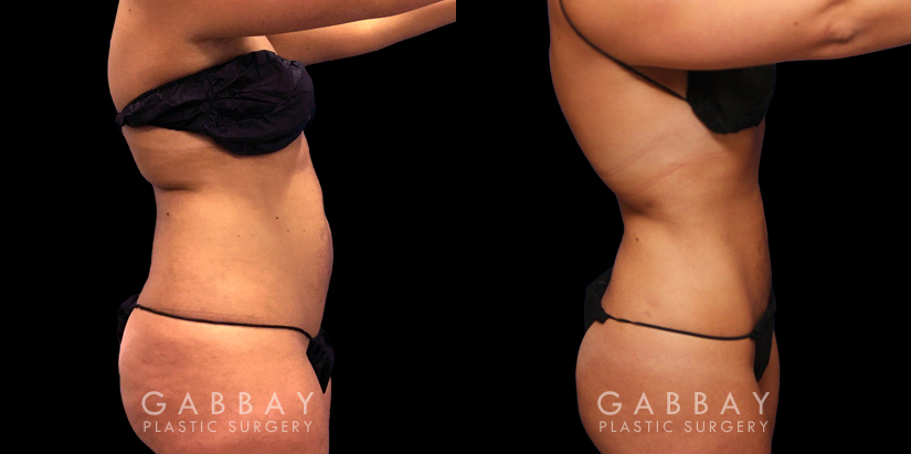 Female patient showing results of her 360 liposuction with a focus on the abdominal area. Patient’s natural figure was enhanced, showing slimmer waist, flattened stomach, and tightened skin.