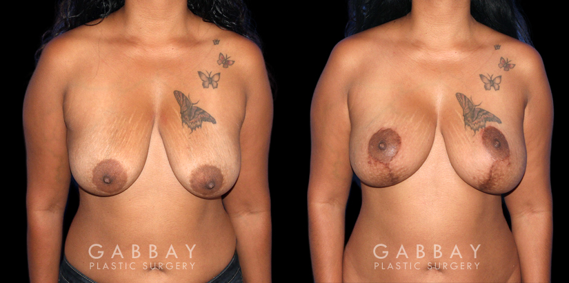 Patient 25 Front View Wise Mastopexy with Silicone Breast Implants Gabbay Plastic Surgery
