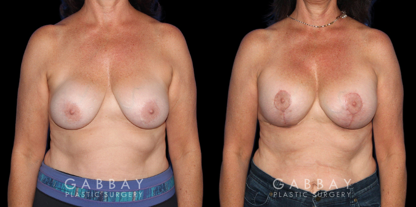Patient 26 Front View R&R Breast Lift Gabbay Plastic Surgery