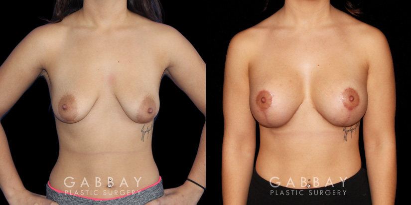 Patient 04 Front View Breast Augmentation w/ Mastopexy - Silicone Gabbay Plastic Surgery