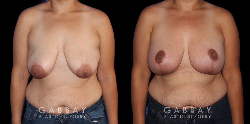 Breast Augmentation – Silicone, Mastopexy