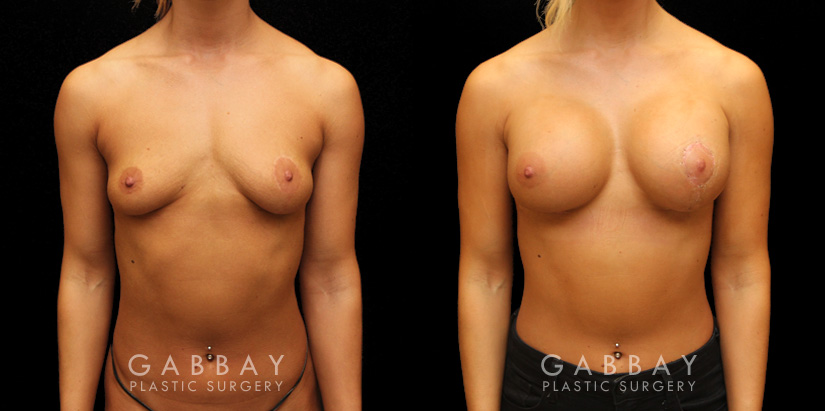 Patient 08 Front View Implants repeal & replacement (left) Gabbay Plastic Surgery
