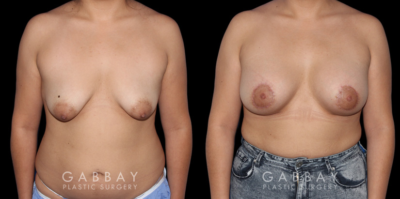 Patient 15 Front View Breast Augmentation - Silicone & Lift Gabbay Plastic Surgery