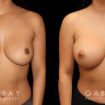 This is a breast augmentation patient who had significant asymmetry. She underwent silicone breast implant augmentation, using different sized high profile Allergan Natrelle Soft Touch implants: 365 cc on the left, 435 cc on the right. Implants were placed below the muscle in a dual plane configuration using an incision that is beautifully hidden within the breast fold.