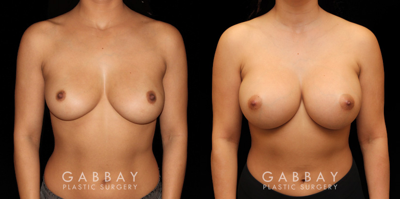 This is a breast augmentation patient who had significant asymmetry. She underwent silicone breast implant augmentation, using different sized high profile Allergan Natrelle Soft Touch implants: 365 cc on the left, 435 cc on the right. Implants were placed below the muscle in a dual plane configuration using an incision that is beautifully hidden within the breast fold.