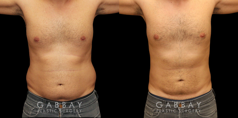 Male liposuction results after reducing stubborn belly fat that would not respond to diet or exercise. The belly area went from significant overhang above the beltline to a flatter contour.