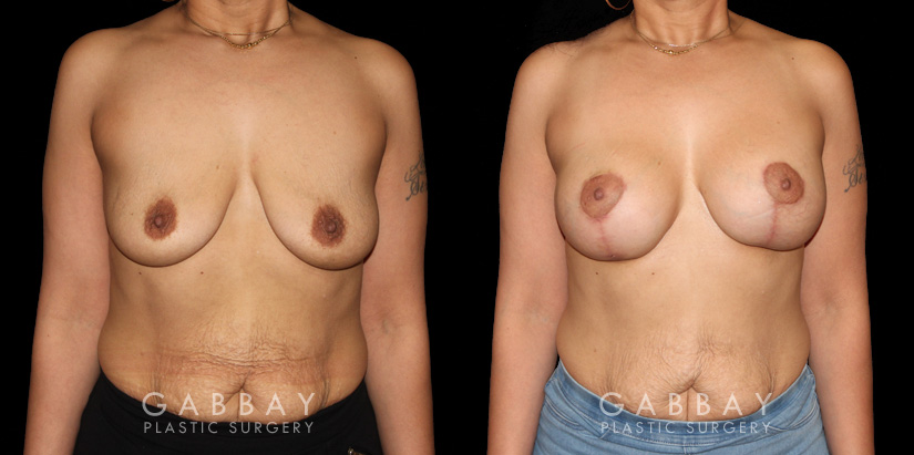 Breast Augmentation – Silicone & Lift