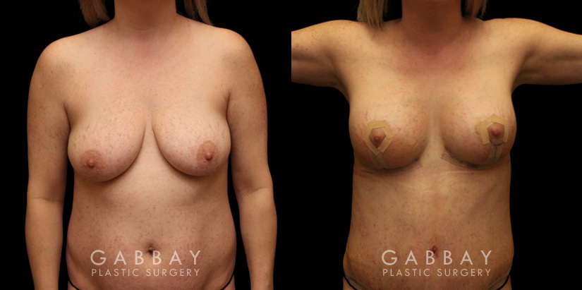 Breast aug/pexy and tummy tuck